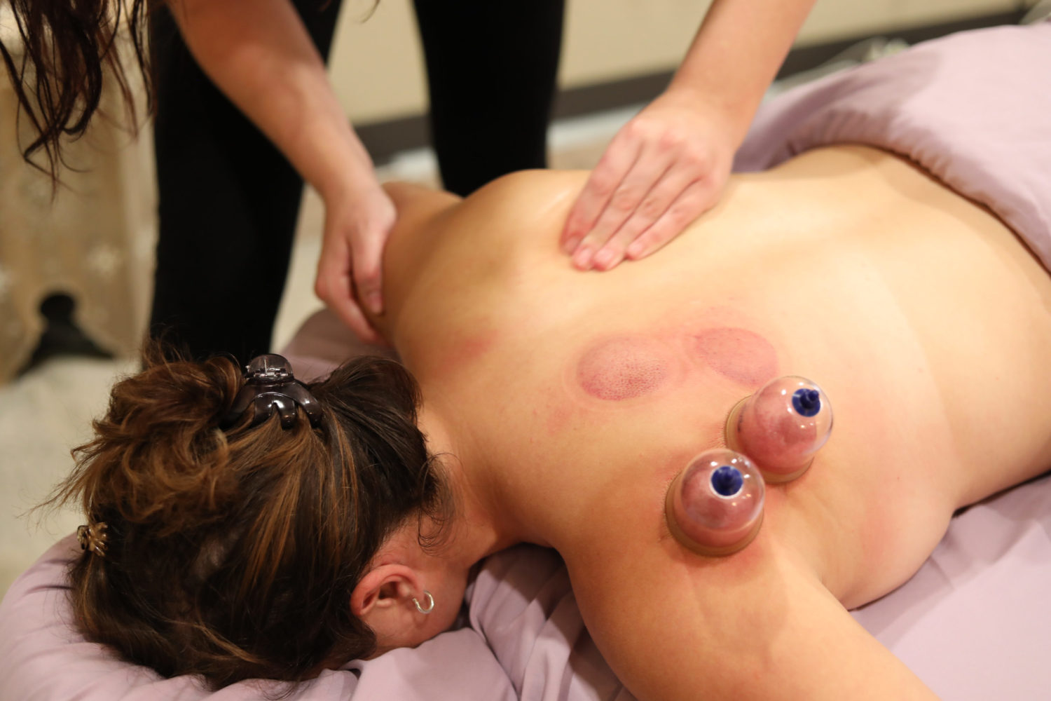 Therapeutic Integration – Cupping Therapy 